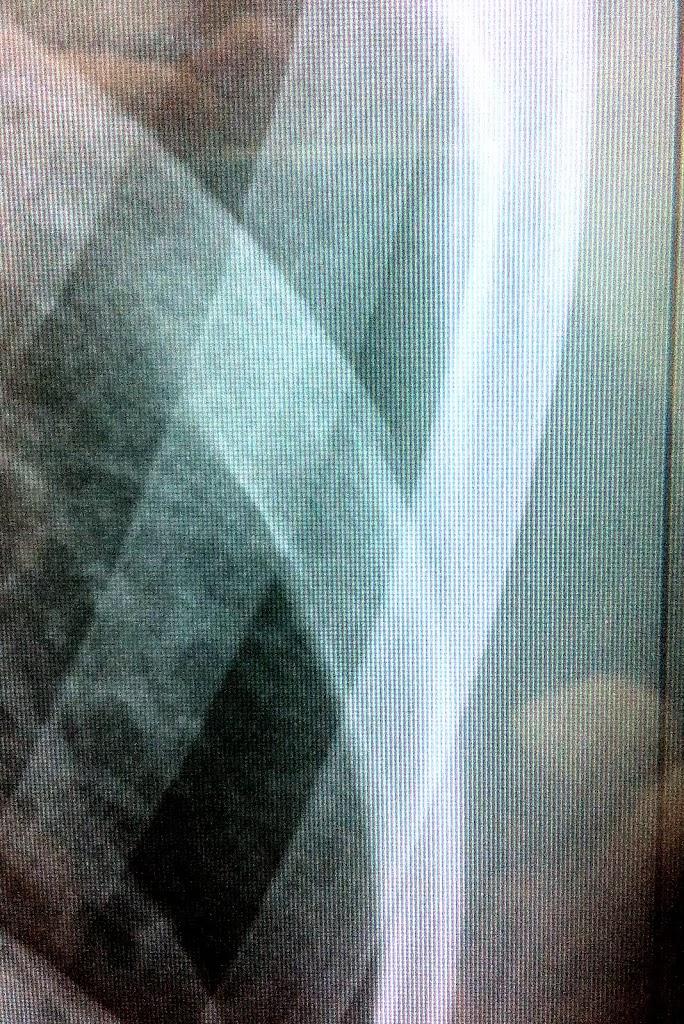 rib_fracture.jpg rib_fracture.jpg